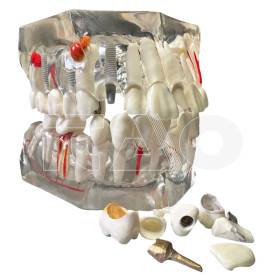 Modello dimostrativo patologie ponti e ricostruzioni 1 pz.